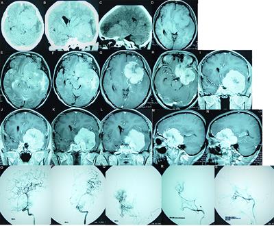 The factors influencing postoperative efficacy of anterior clinoidal meningioma treatment and an analysis of best-suited surgical strategies